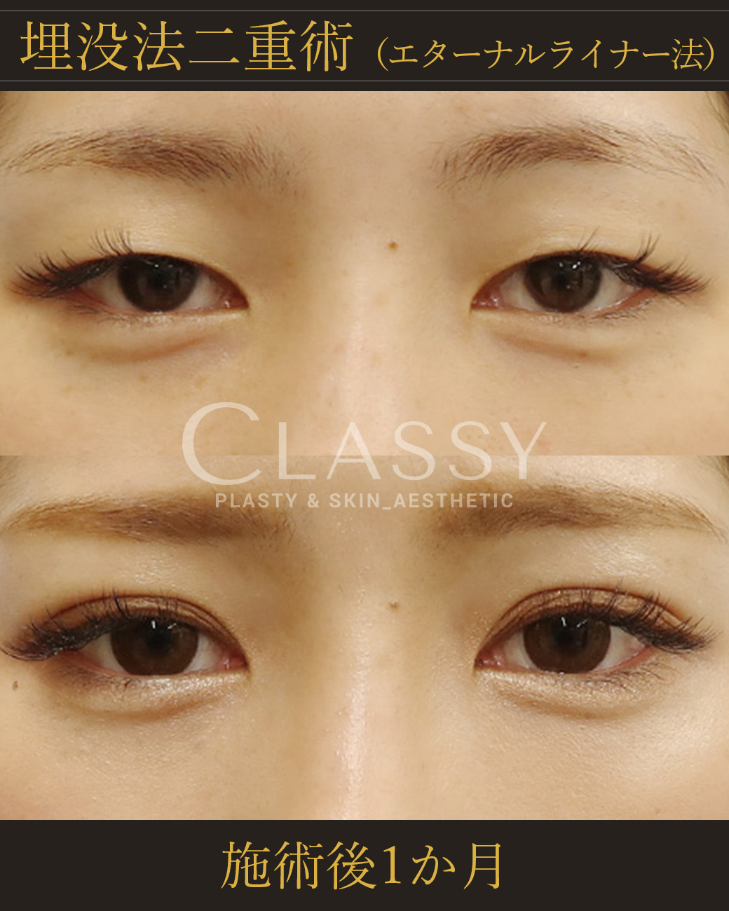 埋没法二重術エターナルライナー法_施術後1か月 | CLASSY仙台美容外科・美容皮膚科