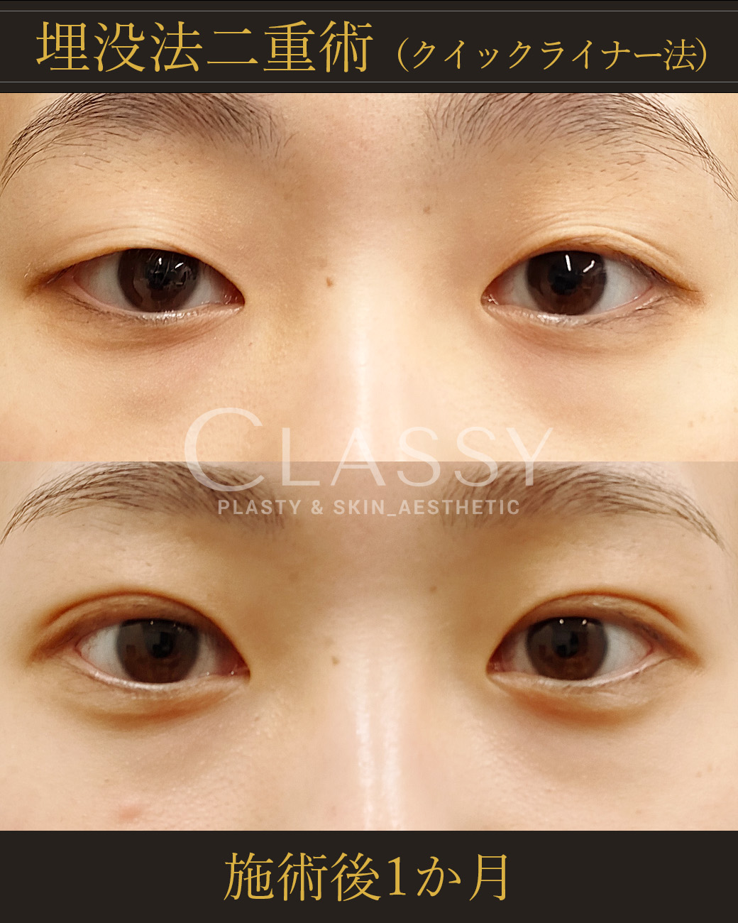 埋没法二重術クイックライナー法_施術後1か月 | CLASSY仙台美容外科・美容皮膚科