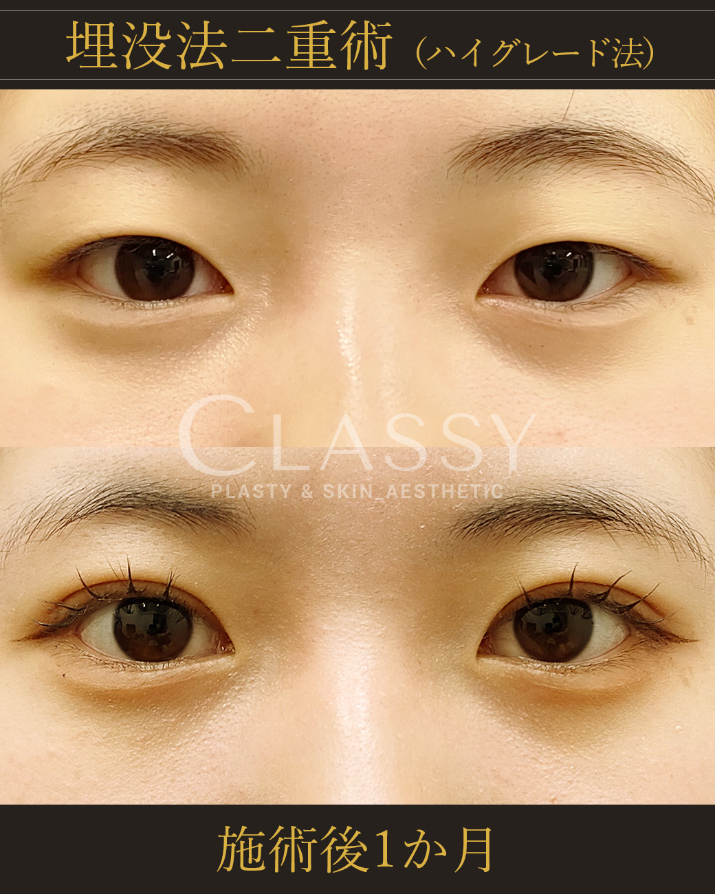 埋没法二重術ハイグレード法_施術後1か月 | CLASSY仙台美容外科・美容皮膚科