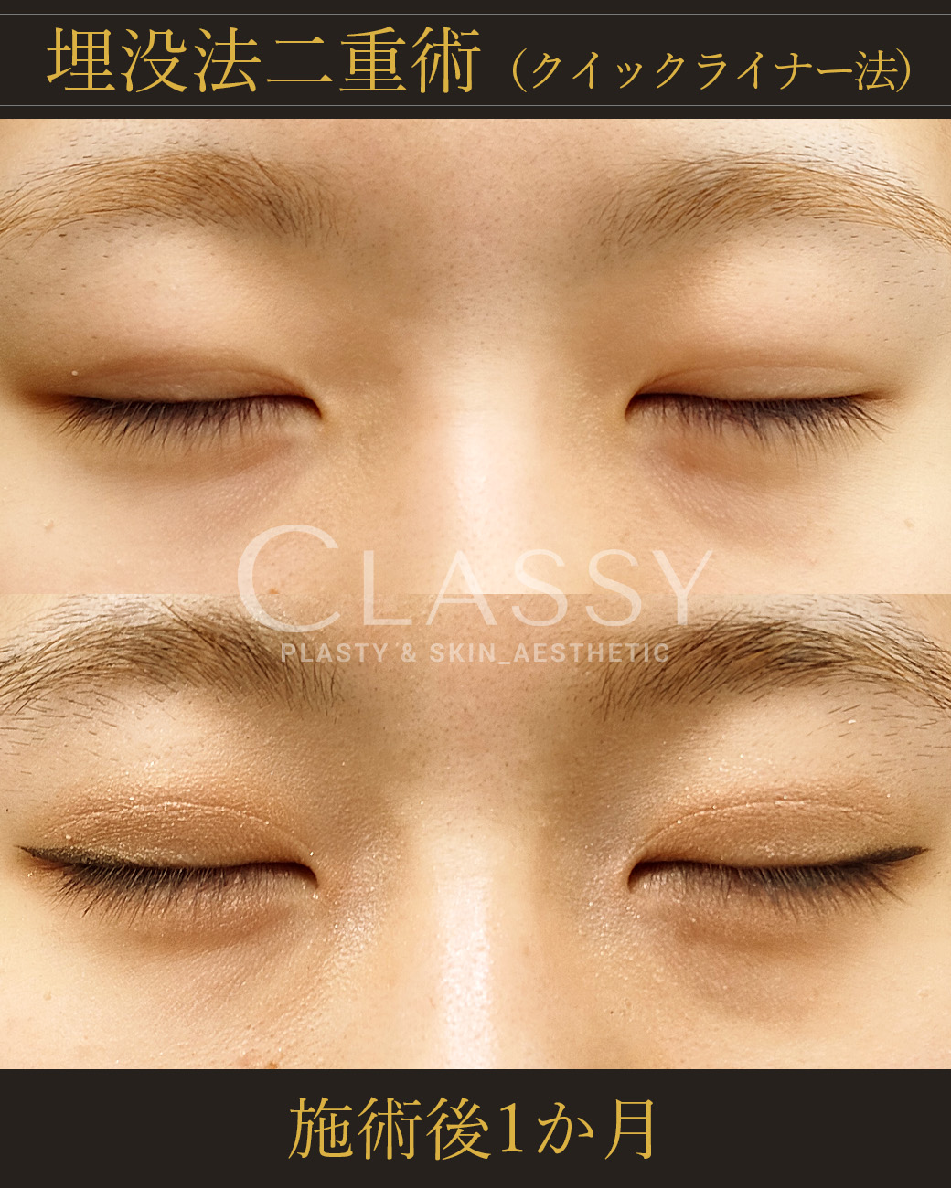 埋没法二重術クイックライナー法_施術後1か月 | CLASSY仙台美容外科・美容皮膚科